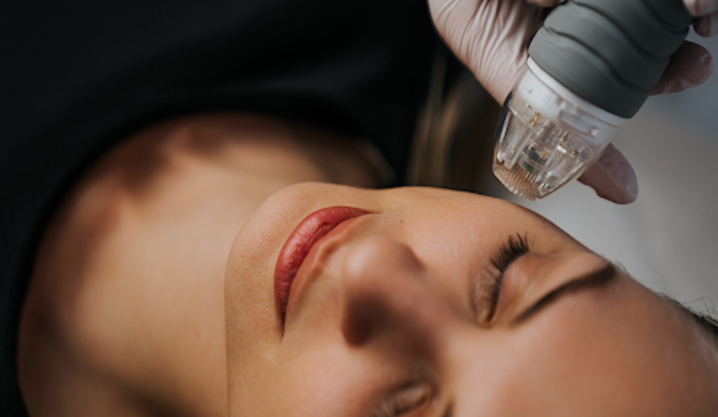 Treating Rough or Dull Skin with RF Microneedling in Brisbane