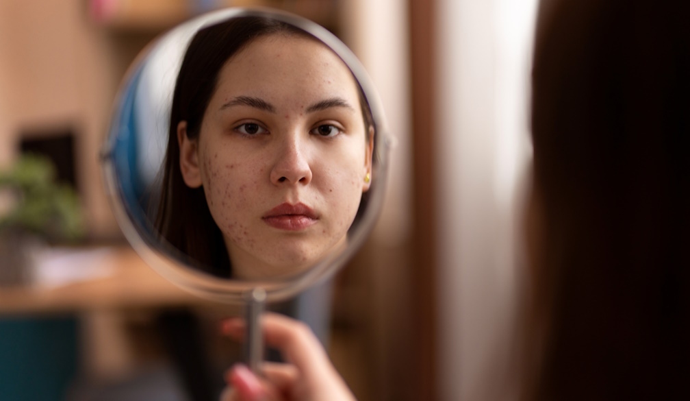 5 Benefits of Seeing a Dermatologist About Acne Scars